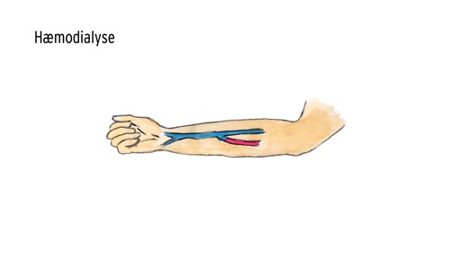 Tegning af en arm, hvor to blodkar er opereret sammen til en fistel.